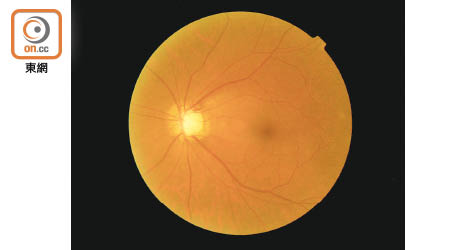 青光眼患者視野周邊變黑，眼底視神經壞死呈淡白色。（資料圖片）
