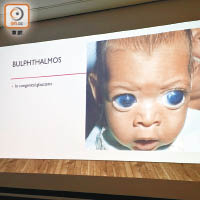 嬰孩出生眼珠恍如「牛眼」般大，可能患小兒青光眼。（關琛詩攝）