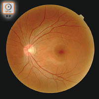 青光眼增加眼壓，令視覺神經逐漸死亡。（資料圖片）