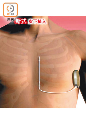 新式的植入心臟除顫器將導線植入皮下，過程中毋須經心臟及血管。