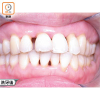 之前積聚牙石令牙肉及牙骨收縮，洗走牙石後有牙縫變大的錯覺。
