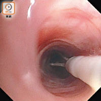 支氣管熱成形術需以小射頻消融探頭置入患者氣管腔。（受訪者提供）