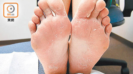 腳板大面積脫皮是「香港腳」的常見徵狀。（資料圖片）