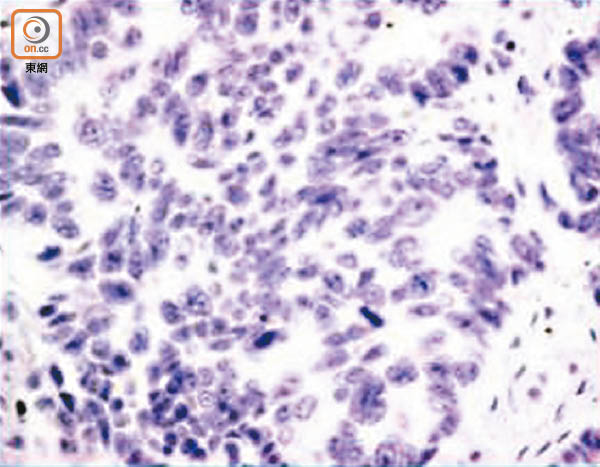 非小細胞肺癌集合多種致癌基因突變。