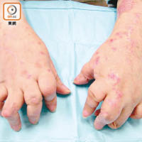 牛皮癬若情況再惡化，有機會令患者有銀屑病關節炎。