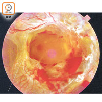增殖性糖尿上眼患者會有眼血管阻塞等問題。（受訪者提供）