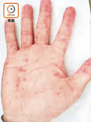患者的手及腳掌會逐漸出現紅疹。