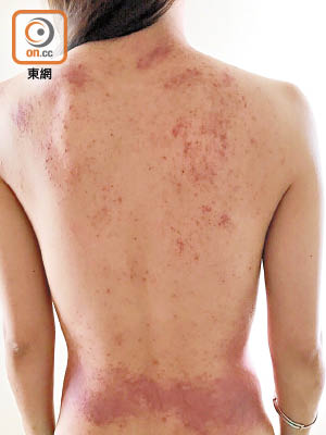 食物敏感初期可致皮膚痕癢及出現紅疹。