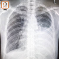 病人的X光掃描圖片清楚顯示，左邊肺部有明顯積液。（受訪者提供）