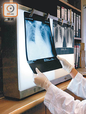 三間公立醫院近期均發生睇漏X光片異常情況的事故。