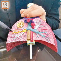 當鼻水或痰倒流至肺部，會導致肺炎等嚴重併發症。