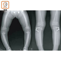 患者的O形腳（左）可以透過引導性增長手術，植入螺絲釘固定（如圖右），限制骨骼按指定方向生長。