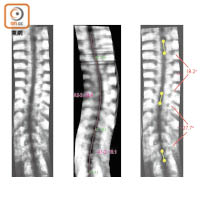 新技術量度脊柱彎度的準確率可媲美X光檢查。