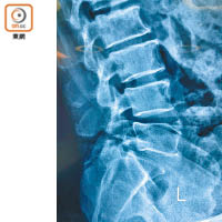 X光檢查只能看到腰骨的組織密度排列。（受訪者提供）