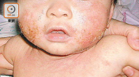 濕疹除令兒童感痕癢和痛楚，亦會影響身心發展。