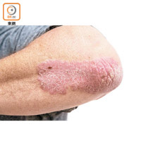 銀屑病患者普遍會出現紅色丘疹或斑塊，且經常受到別人歧視。