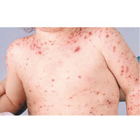 小童感染水痘病毒後，身上會出現多處紅點及水泡。