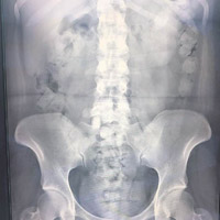 X光片顯示女子體內有多個球狀物體。（互聯網圖片）