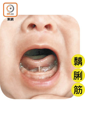 「黐脷筋」患者舌頭下會有一片筋膜，限制舌頭的活動範圍。（受訪者提供）