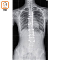 施手術植入螺絲後，成功固定和糾正Toby的脊椎側彎問題。