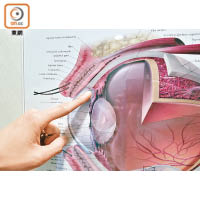 眼球角膜與虹膜交界的「去水位」不能排走液體，導致眼壓高。