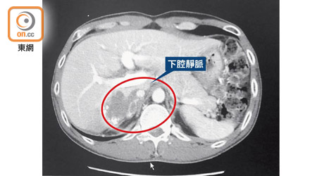 堅雄確診肝癌時，右肝（紅圈示）陰影位置可見腫瘤包囊着下腔靜脈。