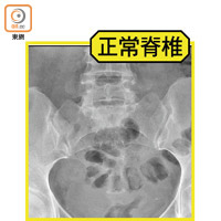 X光片下正常的脊椎情況。（受訪者提供）