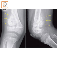 骨骼肌肉腫瘤一般於結節組織發病，最常見是四肢。（受訪者提供）
