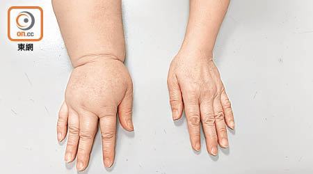 上肢淋巴水腫患者的右手嚴重腫脹，較左手大一倍。（受訪者提供）
