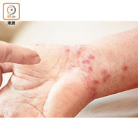 疥瘡患者皮膚表面可能出現紅疹或小水泡。