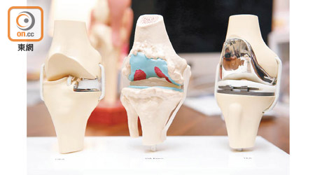局部膝關節置換術保留完好關節，相比傳統手術感覺較自然。
