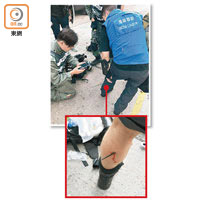 有警員於驅散行動中，被暴徒以弓箭射中，傷及小腿（小圖）。