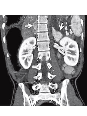 患者體內有嗜鉻細胞瘤（箭嘴示），最終確診「2B型多發性內分泌腫瘤」。（香港醫學雜誌圖片）