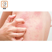 風癩常見症狀包括皮膚出現異常痕癢的紅色丘疹。