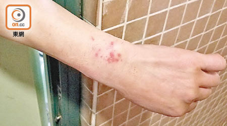 有住戶手腕位置被木蝨咬至多處紅腫。