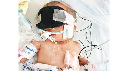 因心臟衰竭而緊急剖腹出生的廿九周早產女嬰小秋彥，已經離世。