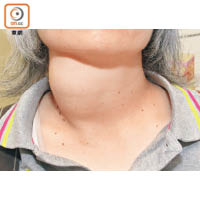 甲狀腺結節能從頸部有異常凸起、腫脹等病徵發現。