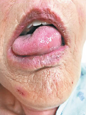 部分患者接受靜脈溶栓治療後會出現舌頭血管性水腫。