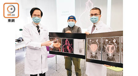 余俊豪（左）及吳志輝（右）介紹前列腺動脈栓塞術。圖中為譚先生。（陳敏琪攝）