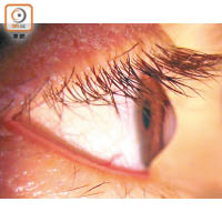 錐形角膜患者的眼角膜中央向外凸出。