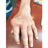 尿酸結晶倘形成在手指關節，會造成活動困難。（受訪者提供）