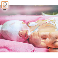 希希出生後於嬰兒加護病房接受觀察及治療。
