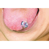 舌頭血管瘤嚴重時可影響日常，患者可做手術切除。