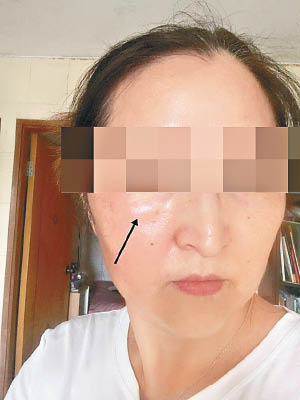 王小姐接種後翌日出現臉部腫脹（箭嘴位置）。（受訪者提供）