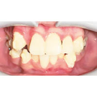 牙石積聚：患者忽略口腔衞生，可能會引致牙菌膜及牙石積聚。（受訪者提供）