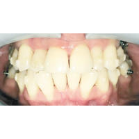 牙肉萎縮：牙肉萎縮以致部分牙根外露。