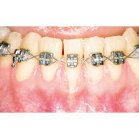 露出牙根：矯齒期間有機會令牙肉萎縮，露出底下牙根。（受訪者提供）