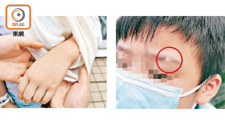 涉事男生昨日展示受傷的左手腕（左圖）及曾拔掉眉毛自殘（右圖）。