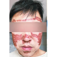 事主X先生指，療程完成後臉部嚴重紅腫。